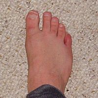 Stubbed toe