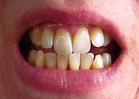 Photo of my front teeth