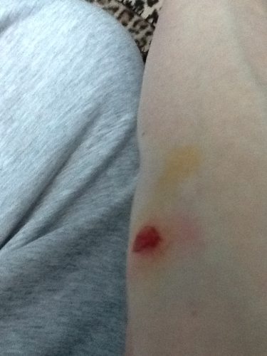 Elbow graze from my fall