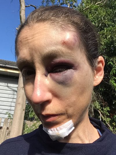 My facial injuries, 24 hours later