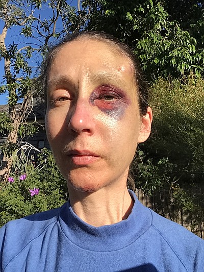 My facial injuries, 15/5