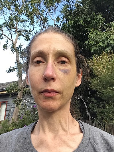 My facial injuries, 29/5/2020